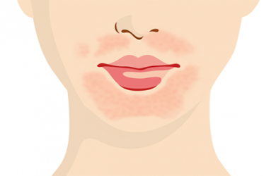 Giải quyết da sẫm màu quanh vùng miệng bằng 5 cách đơn giản tại nhà